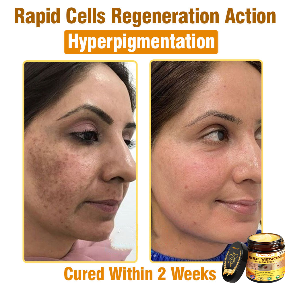 𝐋𝐎𝐕𝐈𝐋𝐃𝐒™ 𝐁𝐞𝐞 𝐕𝐞𝐧𝐨𝐦 𝐀𝐥𝐥-𝐢𝐧-𝐎𝐧𝐞 𝐂𝐫𝐞𝐚𝐦–🌸 Anti-aging,Hydrating, Skin Repair, Even Tone, Acne and Dark Spot Treatment, Wart and Mole Removal, Psoriasis Relief
